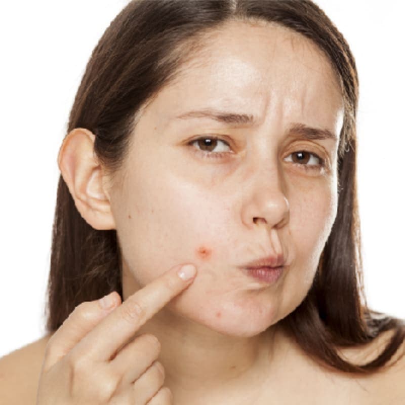 Acne Causes and Treatment [Definitive Guide]
