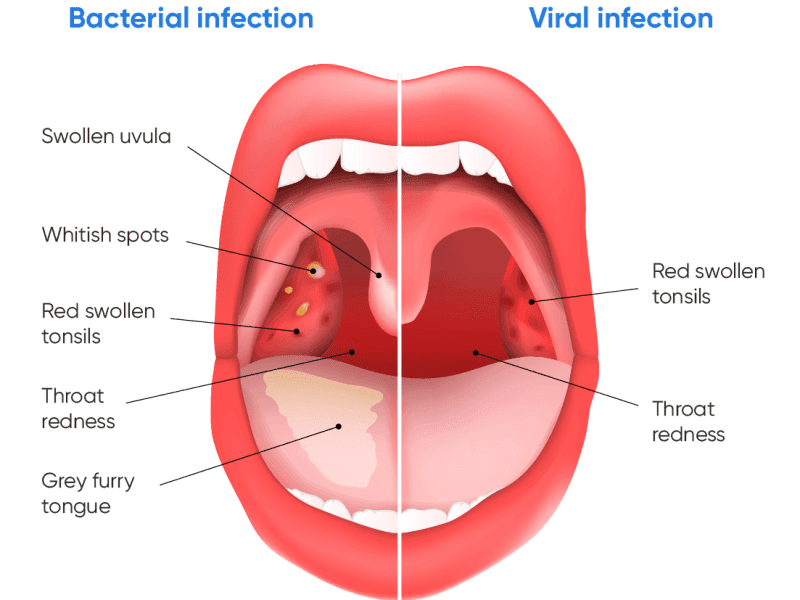 tonsillitis-symptoms-plus-treatment-definitive-guide