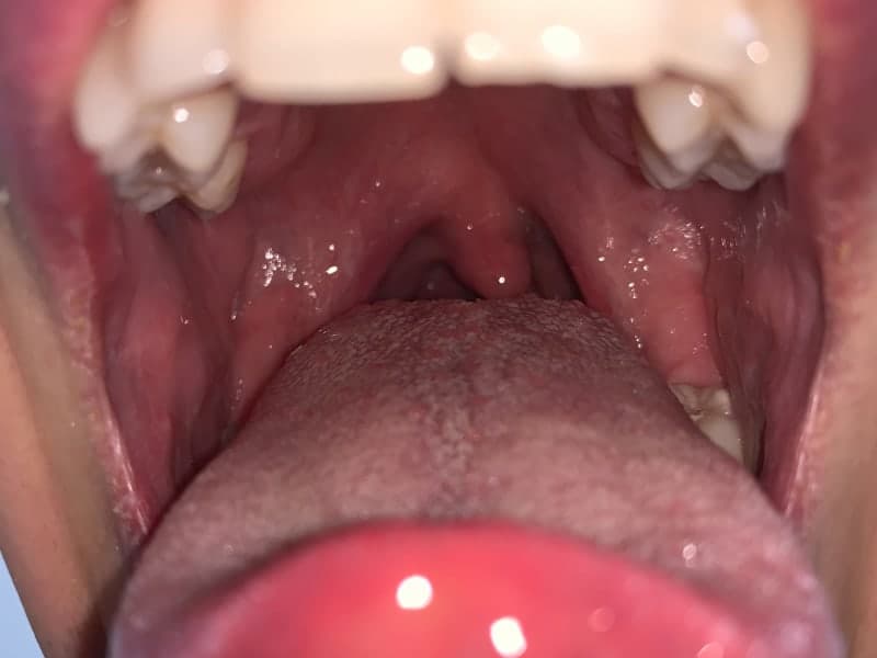 Tonsillitis Symptoms (Plus Treatment) Definitive Guide