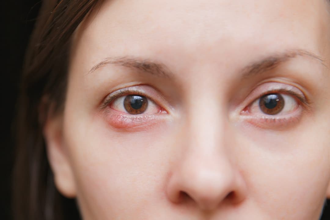 Stye Symptoms, Causes & Treatment [Definitive Guide]